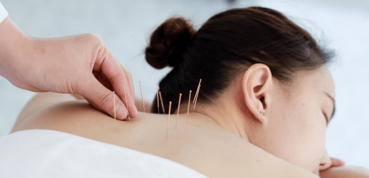 acupuncture points