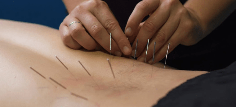 dry needling vs acupuncture
