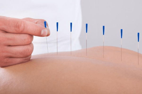 Acupuncture for Diabetes and sugar levels