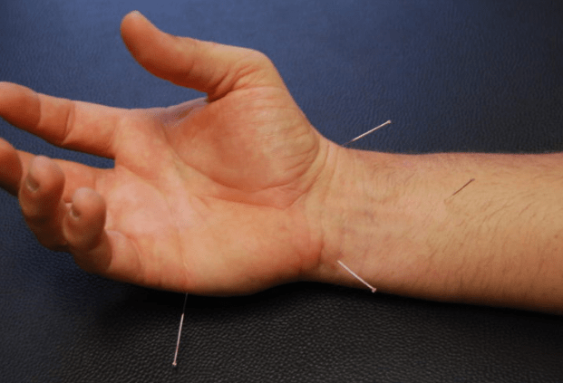 Wrist acupuncture