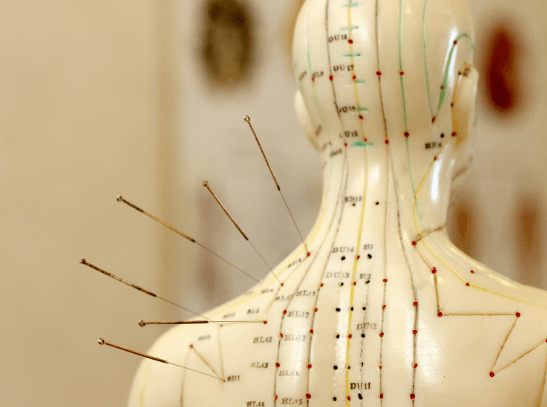 acupuncture treatment