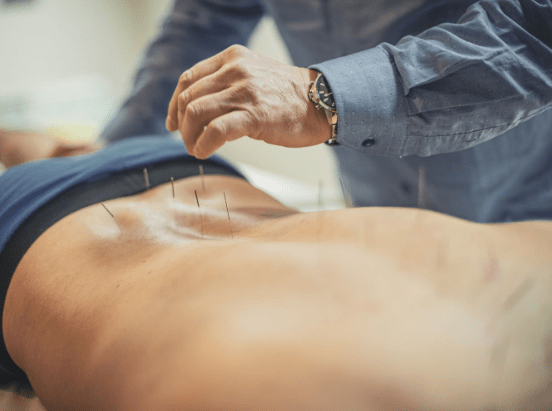 acupuncture therapy